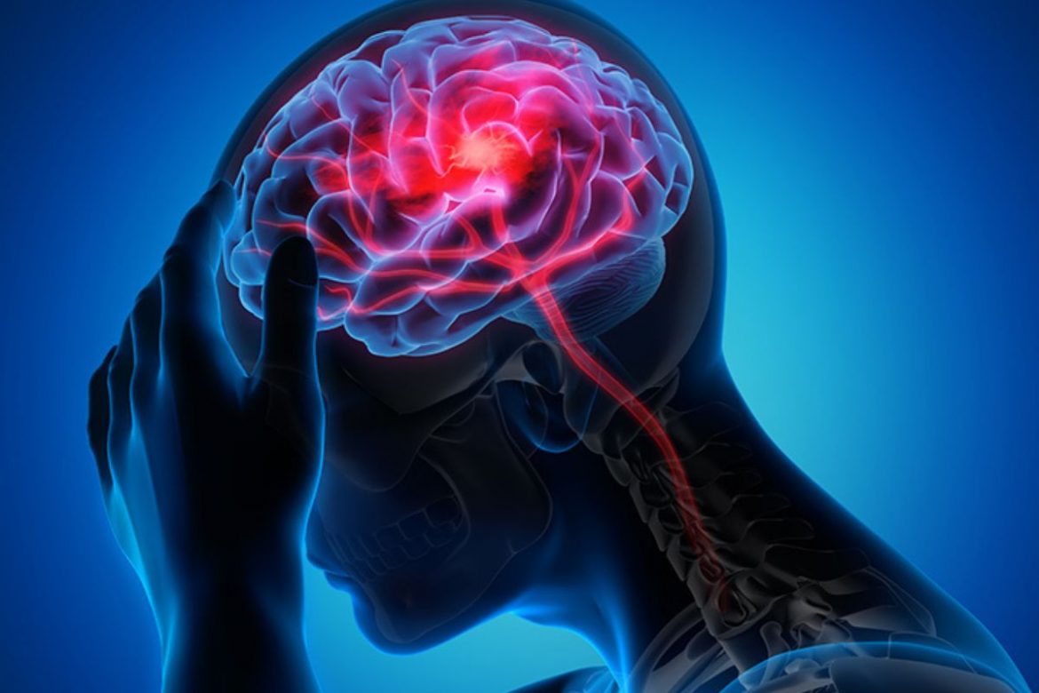 Эркектерде инсульт